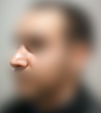 Rhinoplasty After