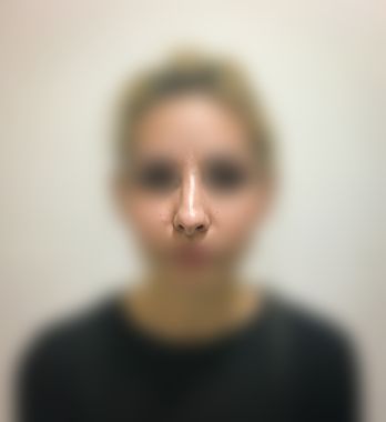 Rhinoplasty After