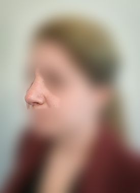 Rhinoplasty After