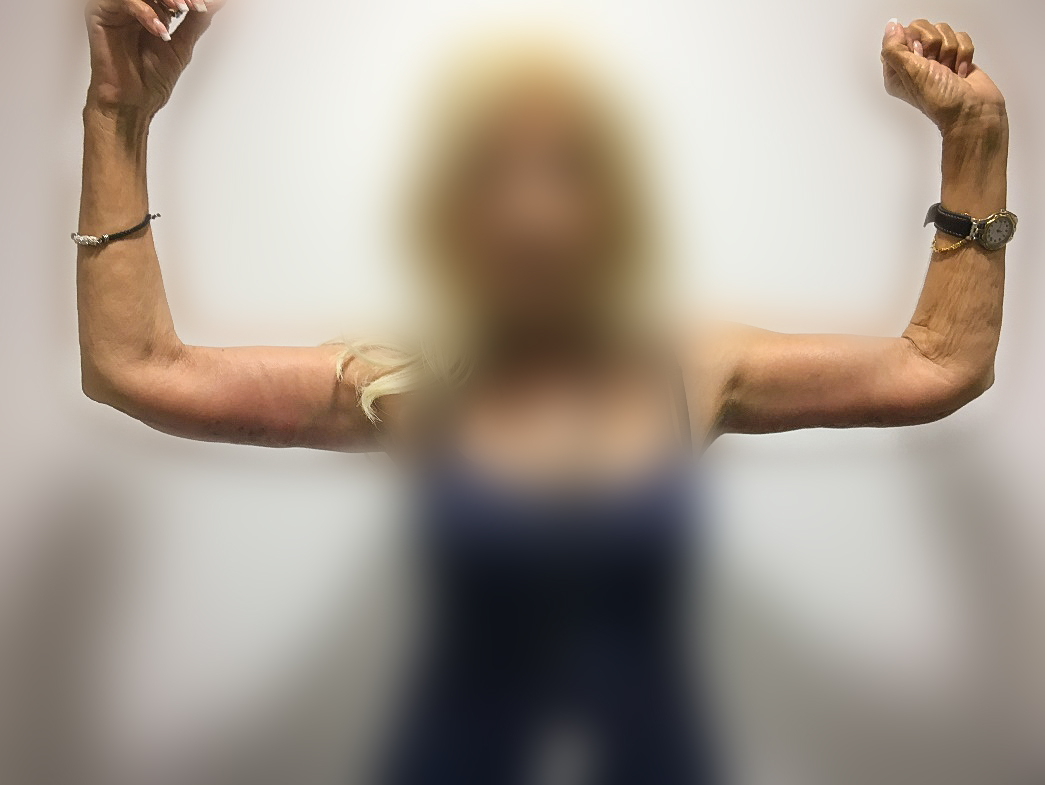 Φωτογραφία ασθενούς μετά την επέμβαση