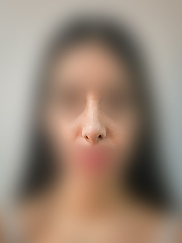Rhinoplasty After