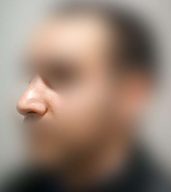 Rhinoplasty After
