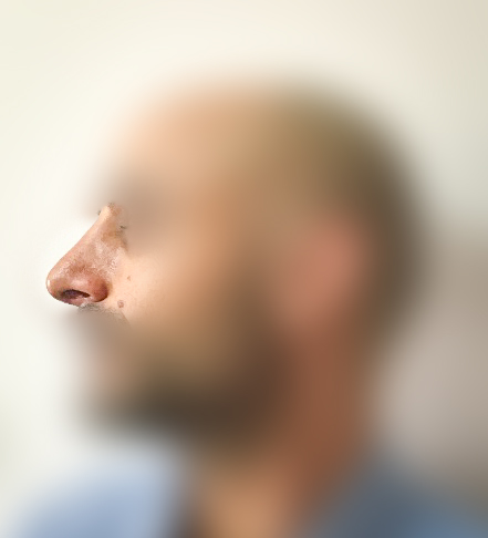 Rhinoplasty After