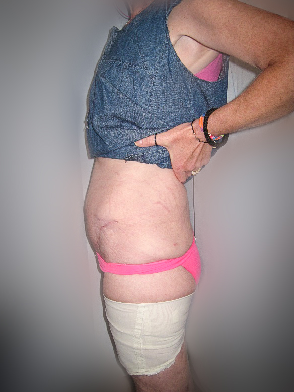 Photo of a patient after surgery