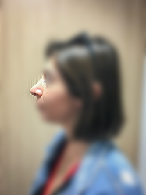 Rhinoplasty After