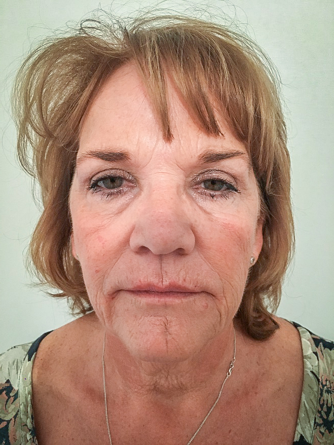 Photo of a patient before surgery