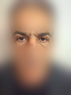 Φωτογραφία ασθενούς πριν την επέμβαση