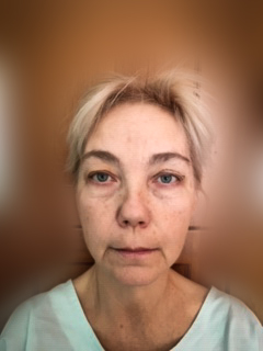 Photo of a patient after surgery